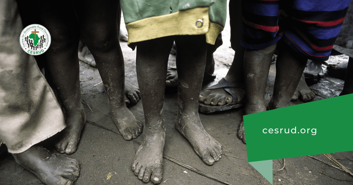 legs of poor children an article by CESRUD on NGO for the poor